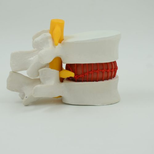 LUMBAR VERTEBRA WITH HEMOCYTE