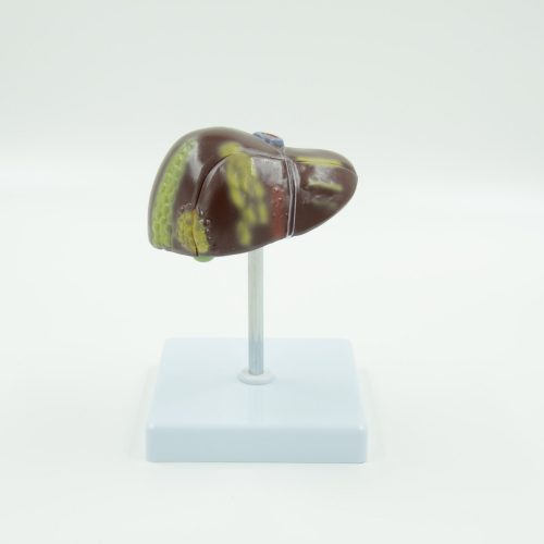 PATHOLOGICAL MODEL OF THE LIVER