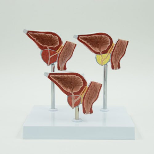 NORMAL AND DISEASED PROSTATE GLAND