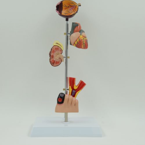 DIABETES MODEL