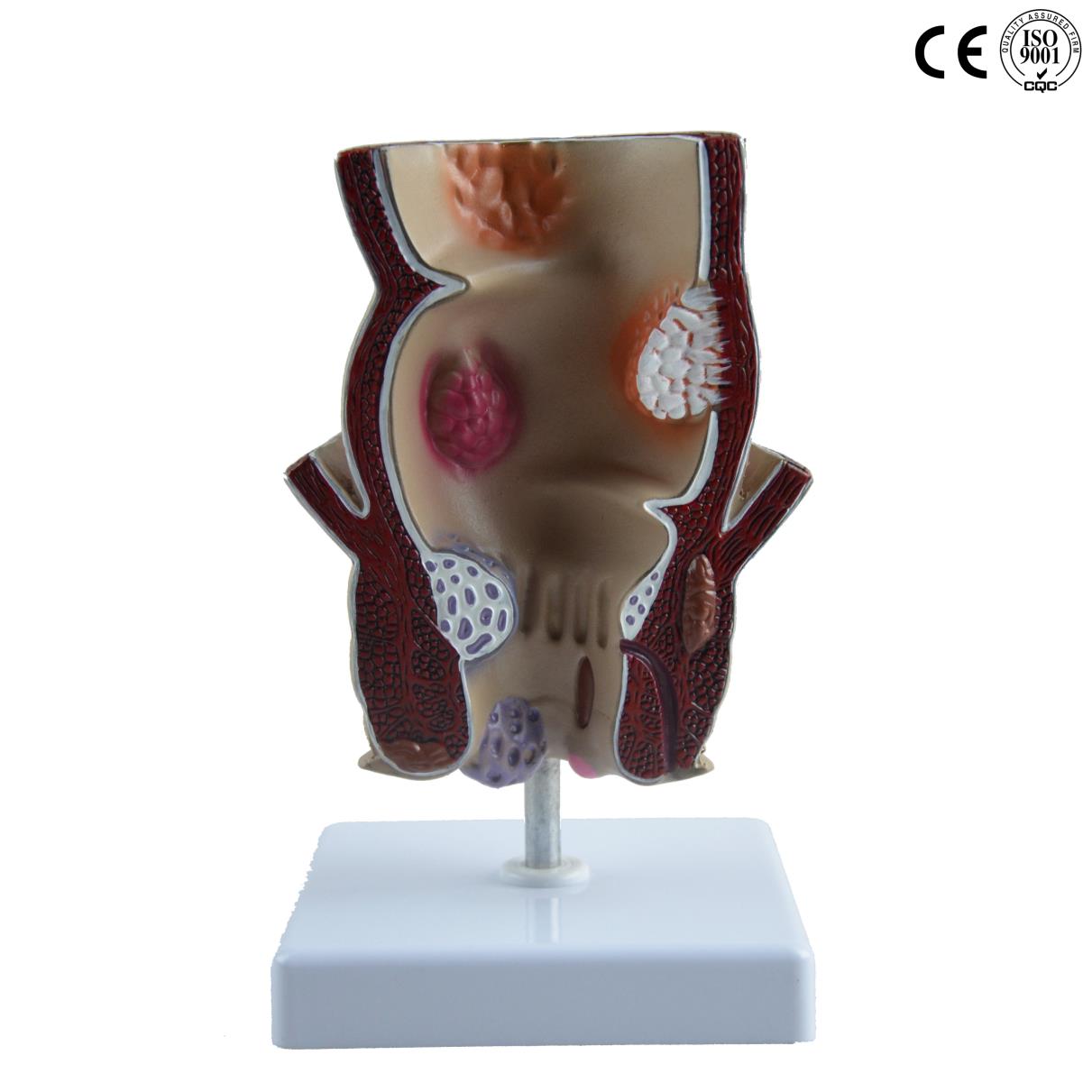 PATHOLOGICAL MODEL OF THE RECTUM