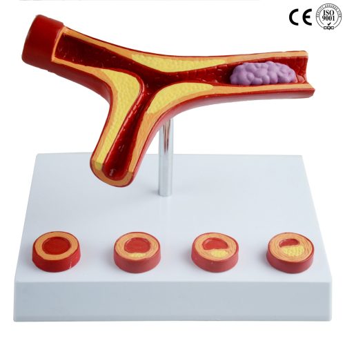 ATHEROSCLEROSIS MODEL WITH THROMBUS